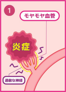 動注治療1