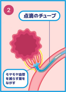 動注治療2