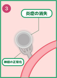 動注治療3